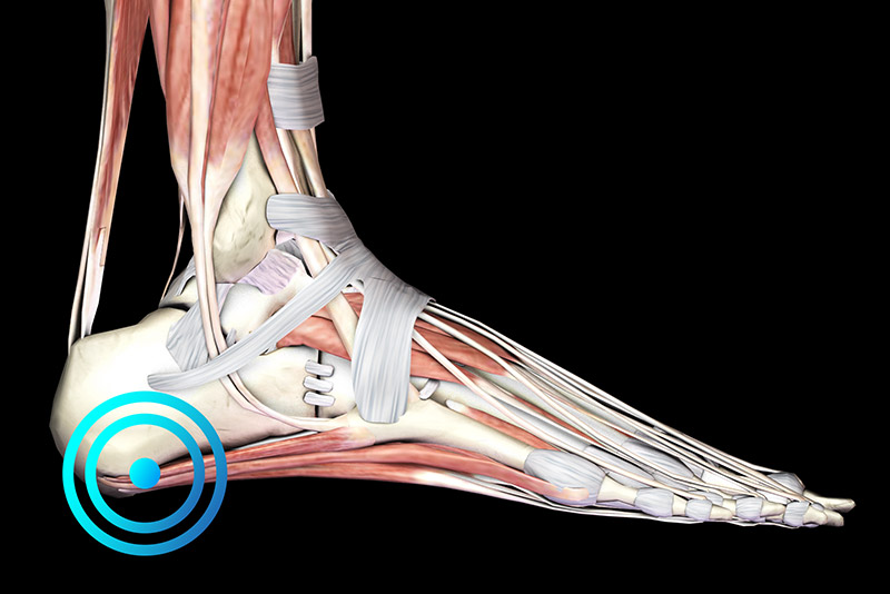 Fasciopatía plantar